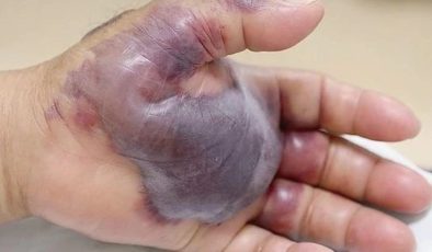 Sağlık Bakanlığı’ndan ‘vibrio bakterisi’ açıklaması